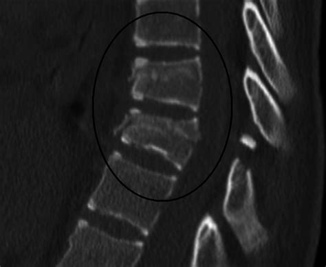 Chance Fractures - StatPearls - NCBI Bookshelf