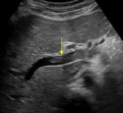 Abdomen and retroperitoneum | 1.1 Liver : Case 1.1.13 Hepatic and portal veins | Ultrasound Cases