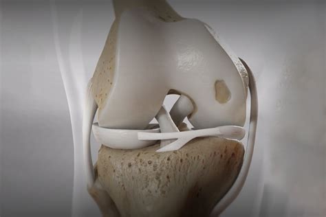 Cartilage Injuries | Dr. Vishnu Unnithan