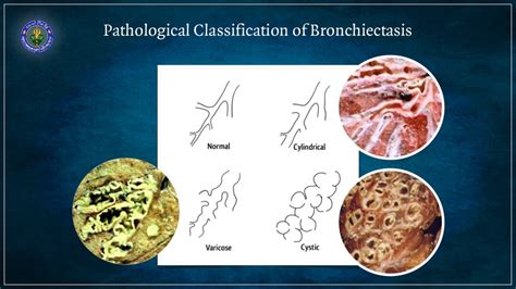 Bronchiectasis - causes and diagnosis