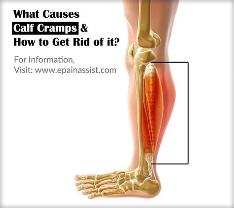 What Causes Calf Cramps & How to Get Rid of it? | Calf cramps, Calf muscle cramps, Calf muscles