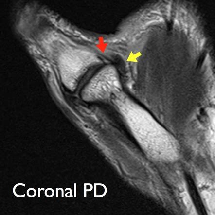 Stener lesion | Radiology Reference Article | Radiopaedia.org