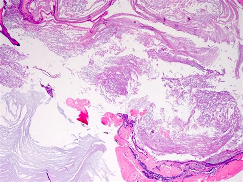 Epidermal Inclusion Cyst Histology