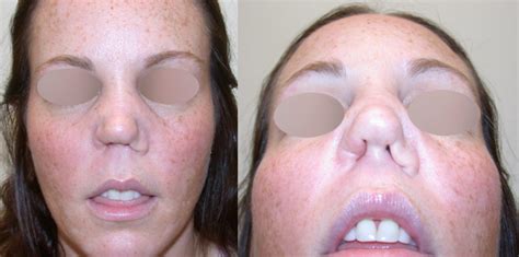 What Effect Does Cocaine Have on the Nose? - Septum Perforation