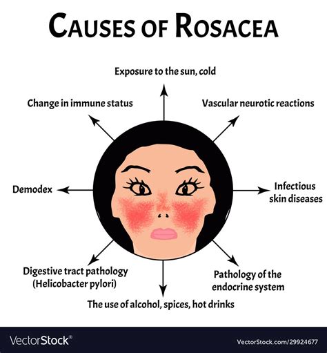 Causes rosacea rosacea awareness month Royalty Free Vector