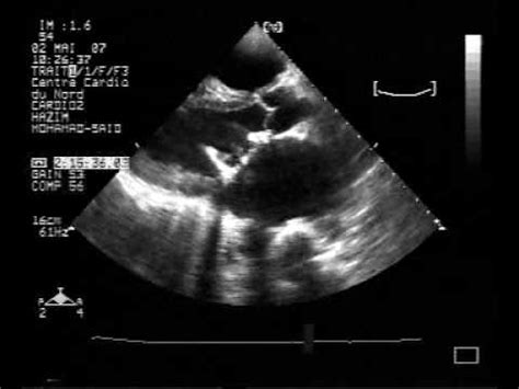 Mitral Valve: Unicuspid Mitral Valve