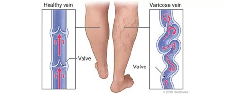 Everything you Need to Know About Varicose Veins - Vein and ...