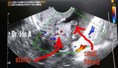 Ultrasound imaging: Small pedunculated fibroid