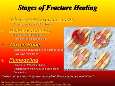 Bone Fracture Healing Stages