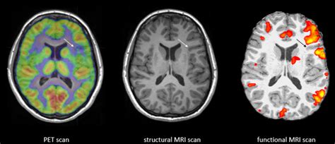 Brain Fmri Scan