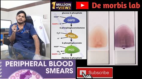 blood peripheral smear in urdu| pancytopenia|deficiency of G6pd - YouTube