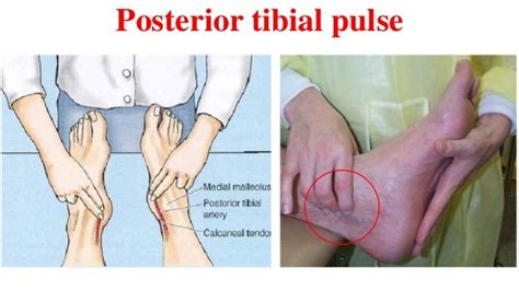 Posterior tibial pulses