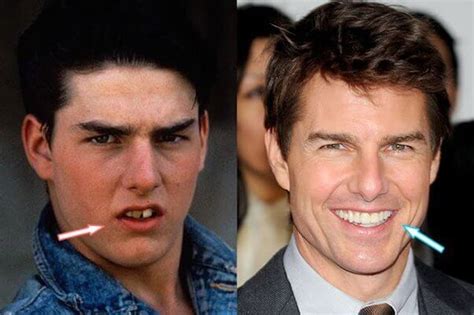 Tom Cruise Plastic Surgery Procedures - Milano Klinik