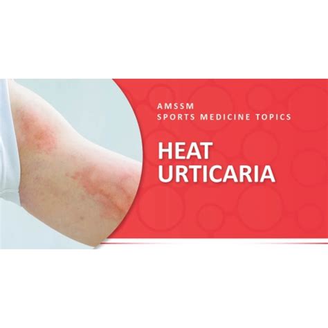 HEAT URTICARIA | Sports Medicine Today