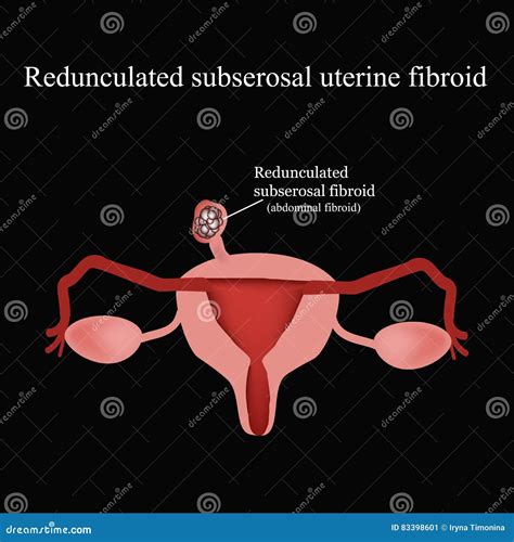 Pedunculated Subserous Uterine Fibroids. Infographics. Vector ...