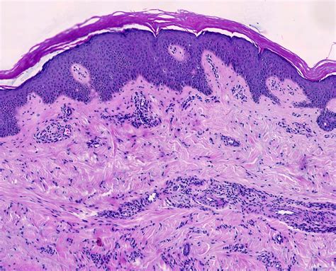 Dermatofibroma Histology