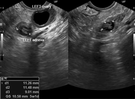 Ectopic Pregnancy Ultrasound