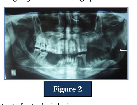 Figure 3 from VANISHING BONE DISEASE OF MANDIBLE: A CASE REPORT | Semantic Scholar