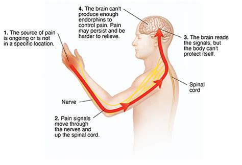 Understanding Chronic Pain - Ask The Nurse Expert