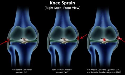 Blood Treatment For Cancer: Knee Buckling Treatment