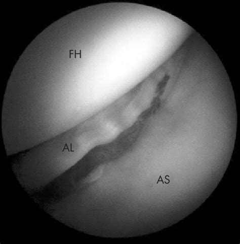 A peripheral tear of the acetabular labrum. AL, acetabular labrum; AS,... | Download Scientific ...