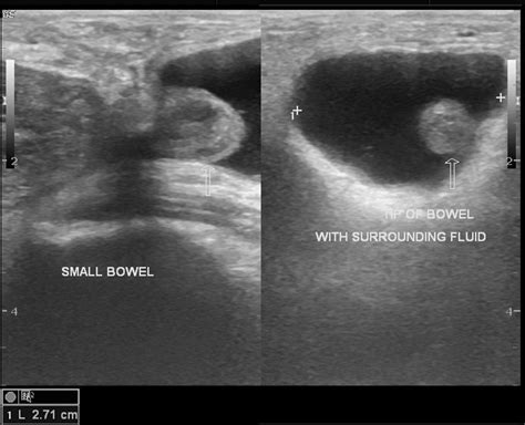 Femoral hernia diagnostic study of choice - wikidoc