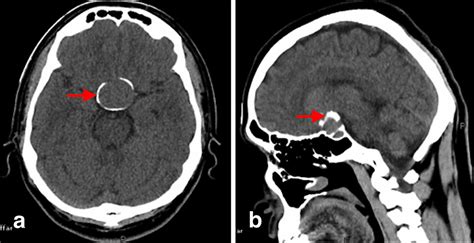 Pituitary Adenoma with Calcifications: A Case Report | Cureus