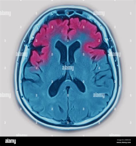 Brain atrophy alzheimer hi-res stock photography and images - Alamy