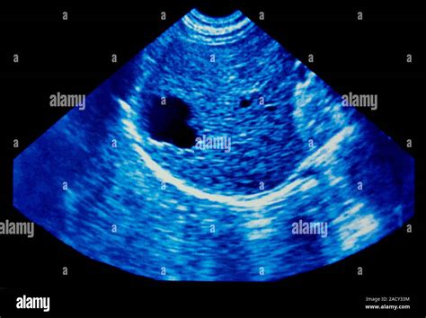 Liver cyst. Coloured ultrasound image of a cyst (dark, centre-left) in ...