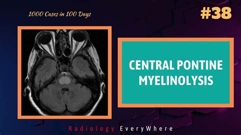 CENTRAL PONTINE MYELINOLYSIS Radiology Tutorials 1000 videos in 100 days video 38 - YouTube