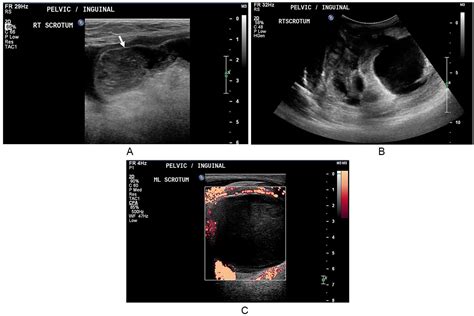 Indirect Inguinal Hernia Ultrasound