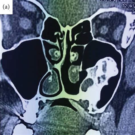 (a, b) CT scan showing a large mass in the left antrum,... | Download Scientific Diagram