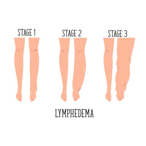 Guide to Lymphedema Treatment - PRN Home Health and Therapy