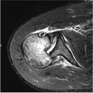 1st patient: MRI scan showing PSD, reverse Hill-Sachs lesion, impaction ...