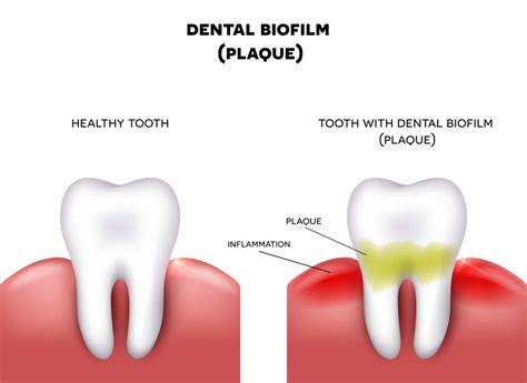 Why Dental Plaque and Tartar Need to Be Removed from Teeth
