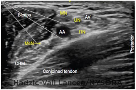 Ultrasound-Guided Axillary Brachial Plexus Block - NYSORA The New York School of Regional Anesthesia