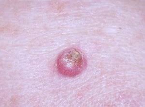 Keratoacanthoma - Pictures, Diagnosis, , Symptoms, Treatment