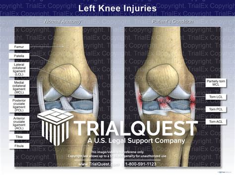 Left Knee Injuries - TrialExhibits Inc.