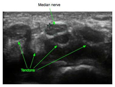 Ultrasound Measurements | Carpal-Tunnel.net