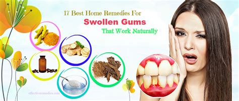 17 Best Home Remedies For Swollen Gums That Work Naturally