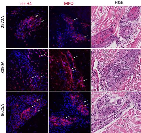 NETs are present in skin lesions from patients with levamisole-induced ...