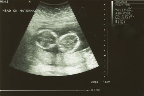 twin cuteness in utero! | Fleurishing