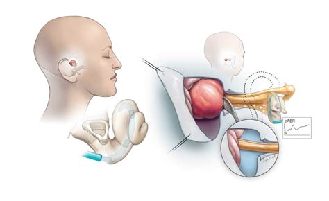 Acoustic Neuroma - Otolaryngology–Head & Neck Surgery