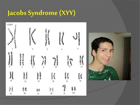 Xyy Syndrom