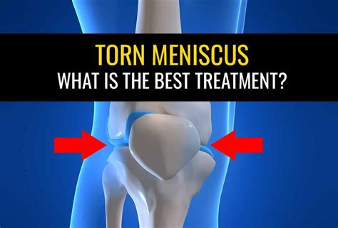 Meniscus Tear Treatment | Torn Meniscus Exercises