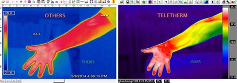 Medical infrared thermal imaging cameras from Teletherm for health evaluations