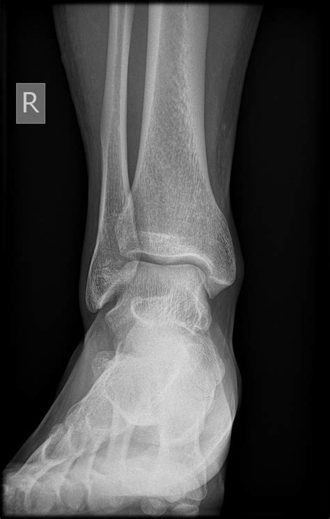 Normal Left Ankle Xray