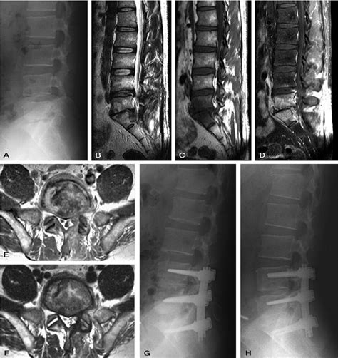 A 47year-old man with L5-S1 pyogenic spondylitis. (A) Preoperative ...