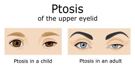 What Is Ptosis? - Symptoms, Causes & Treatment - Allure Plastic Surgery