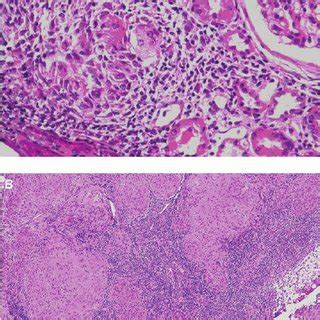 ( A ) Renal histology showing non-caseating granuloma (arrow) and... | Download Scientific Diagram